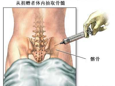 骨髓移植