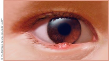 某些感染性的眼睑炎会伴有结膜炎. 正在加载,请耐心等待