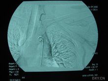 颅内肉芽肿性动脉炎