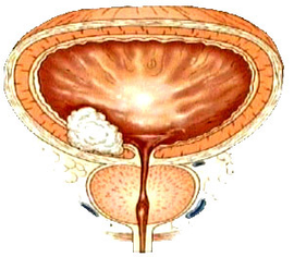 尿道肿瘤_360百科