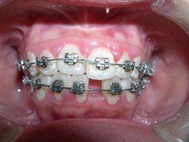 自锁托槽牙齿矫正