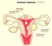 子宫肌瘤合并妊娠