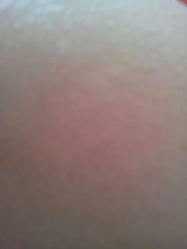 皮肤过敏治疗偏方_360百科