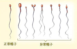 精子精液异常