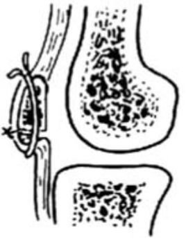 髌骨骨折切开复位内固定术
