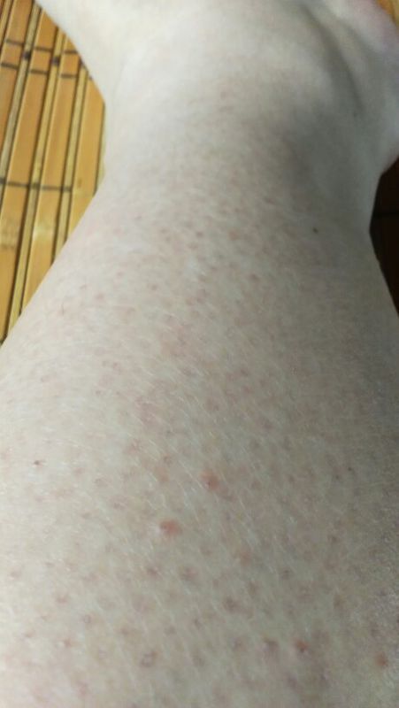 皮肤是鸡皮肤 咋能改善_(:з」∠)__360问答