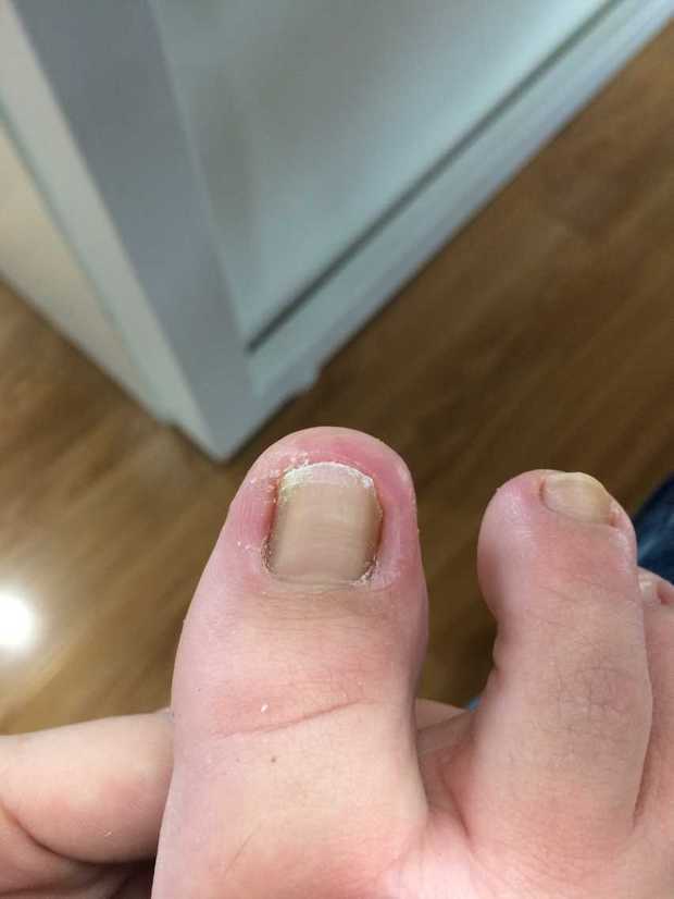 脚趾甲变厚变黄 凹凸不平 大脚趾还很痛 怎么回事