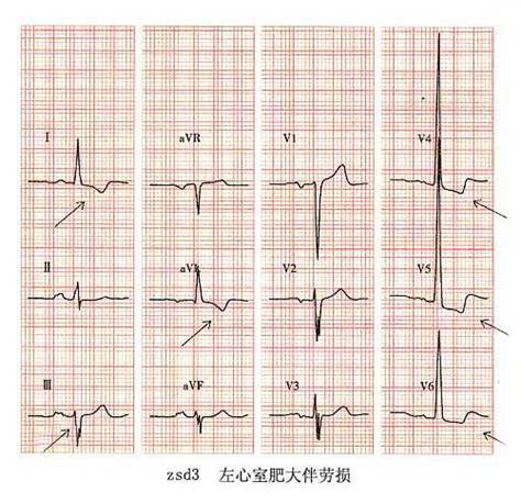 左室高電壓